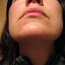Day 5 peel 2